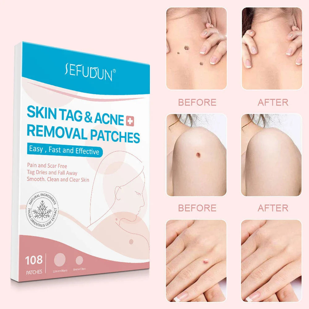 Skin Tag Remover Patches - Effectively remove skin tags without pain or scarring for flawless, radiant skin