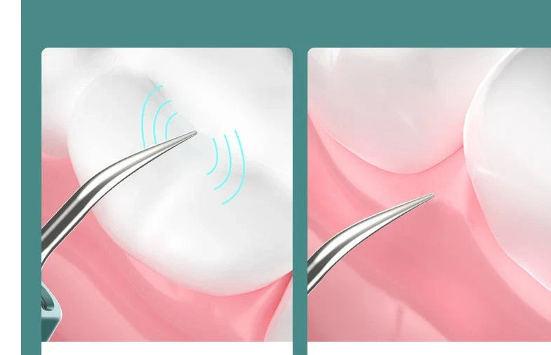 Advanced Ultrasound Dental Cleaner with HD Visual - Powerful Plaque and Tartar Removal Tool