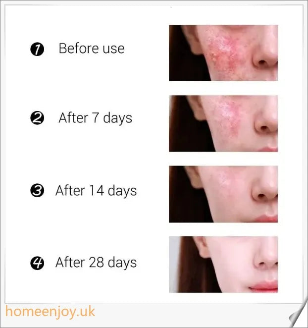 Acne Treatment Face Cream infused with mango extract to moisturise, brighten, and control oil for a flawless, radiant complexion
