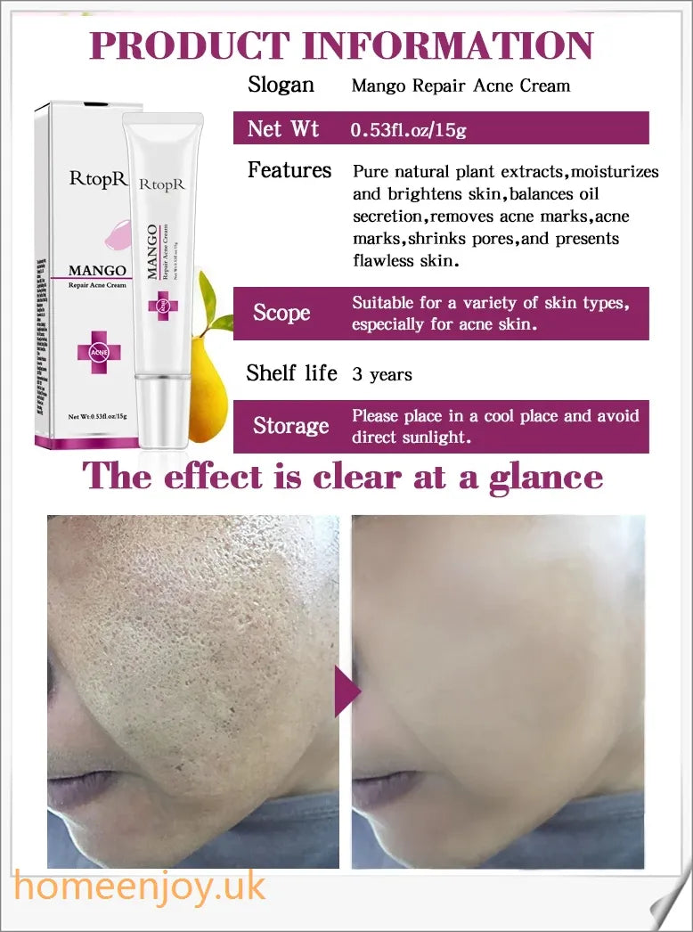 Acne Treatment Face Cream infused with mango extract to moisturise, brighten, and control oil for a flawless, radiant complexion