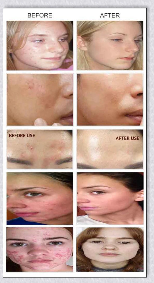 Mabox Award Winning Acne Clarifying Vitamin C Serum - A powerful skincare solution to combat breakouts and nourish skin