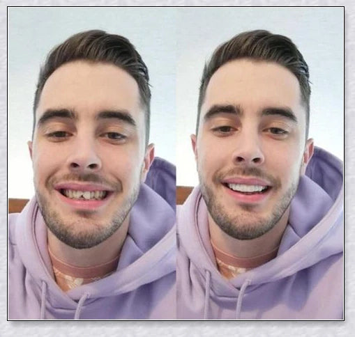 Premium teeth veneers that instantly transform your smile by concealing crooked, stained, or missing teeth