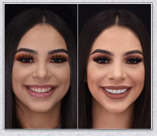 Premium teeth veneers that instantly transform your smile by concealing crooked, stained, or missing teeth