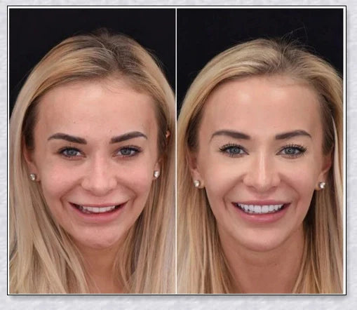 Premium teeth veneers that instantly transform your smile by concealing crooked, stained, or missing teeth