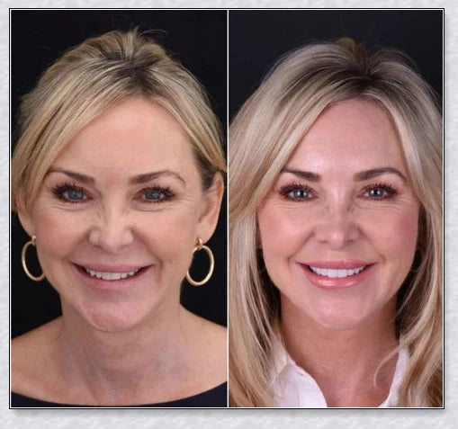 Premium teeth veneers that instantly transform your smile by concealing crooked, stained, or missing teeth