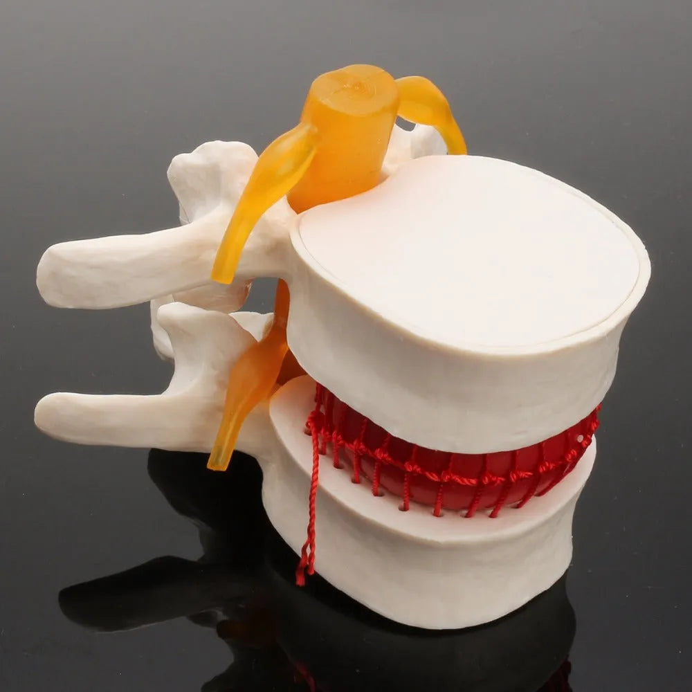 White PVC anatomical model showing a lumbar spinal disc herniation for medical demonstration.