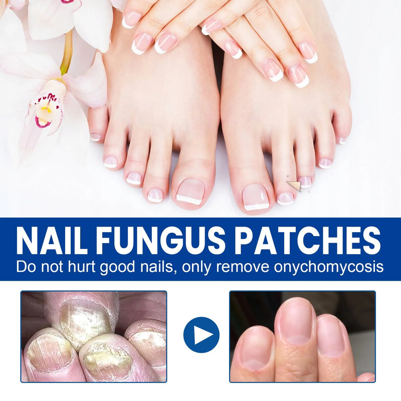 Nail repair adhesive bandage patches with glycerin, allantoin, garlic extract, tea tree oil and vitamin E in a pack of 32 patches measuring 6.1 cm by 3.5 cm for nail nursing and cuticle care.