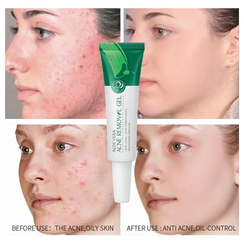 Green aloe acne treatment gel in Laiko Aloe Gel series with glycerin, 3-year shelf life