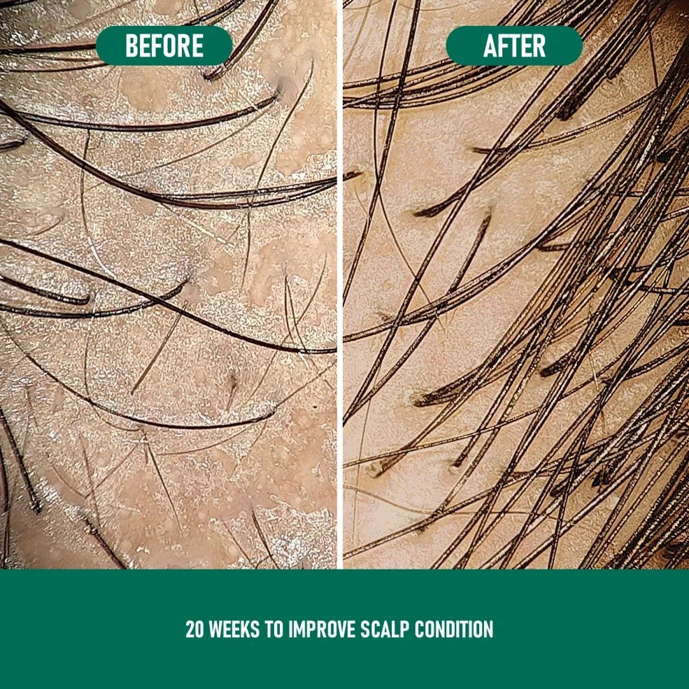 CH004 Minoxidil 5% anti-hair loss mousse canister with foam dispenser
