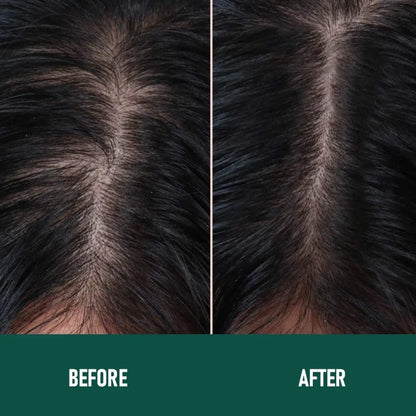 CH004 Minoxidil 5% anti-hair loss mousse canister with foam dispenser