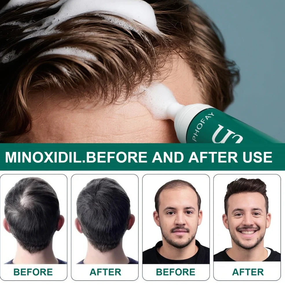 CH004 Minoxidil 5% anti-hair loss mousse canister with foam dispenser
