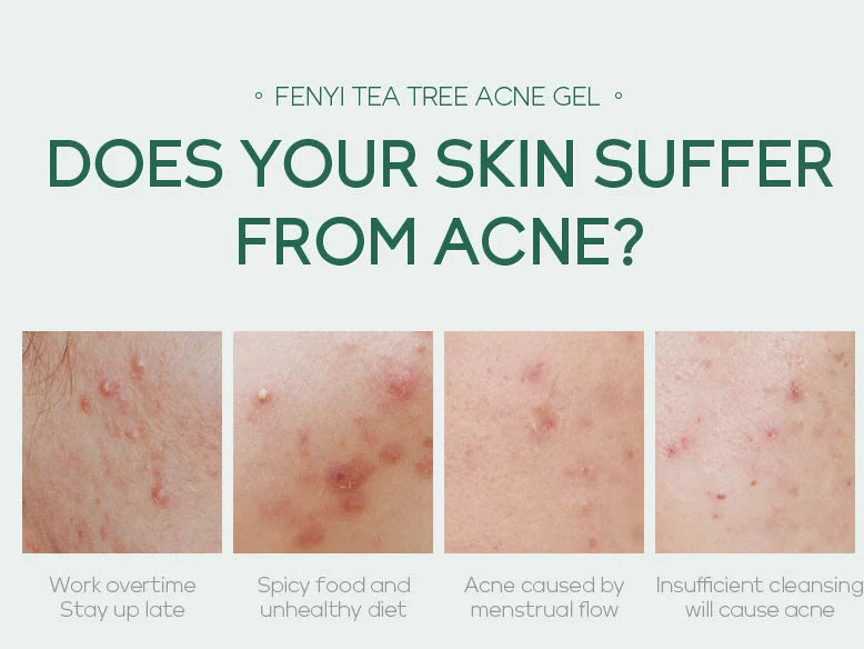20g moisturising skincare container with acne medicine and tea tree oil formula
