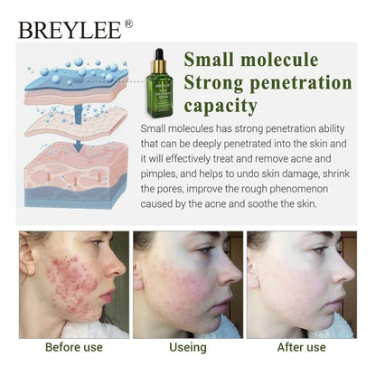 BREYLEE Acne Treatment Serum with plant extracts for acne-prone skin