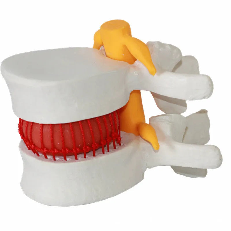 White PVC anatomical model showing a lumbar spinal disc herniation for medical demonstration.