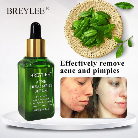 BREYLEE Acne Treatment Serum with plant extracts for acne-prone skin