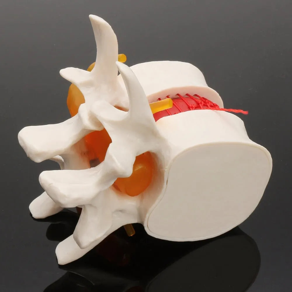 White PVC anatomical model showing a lumbar spinal disc herniation for medical demonstration.