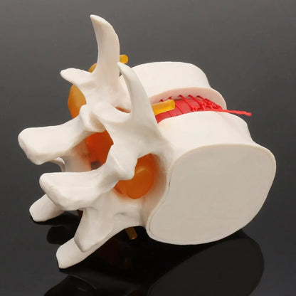 White PVC anatomical model showing a lumbar spinal disc herniation for medical demonstration.