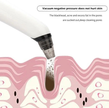 Blackhead suction instrument with oval, small round, and large round suction heads plus microcrystalline tip for facial treatment