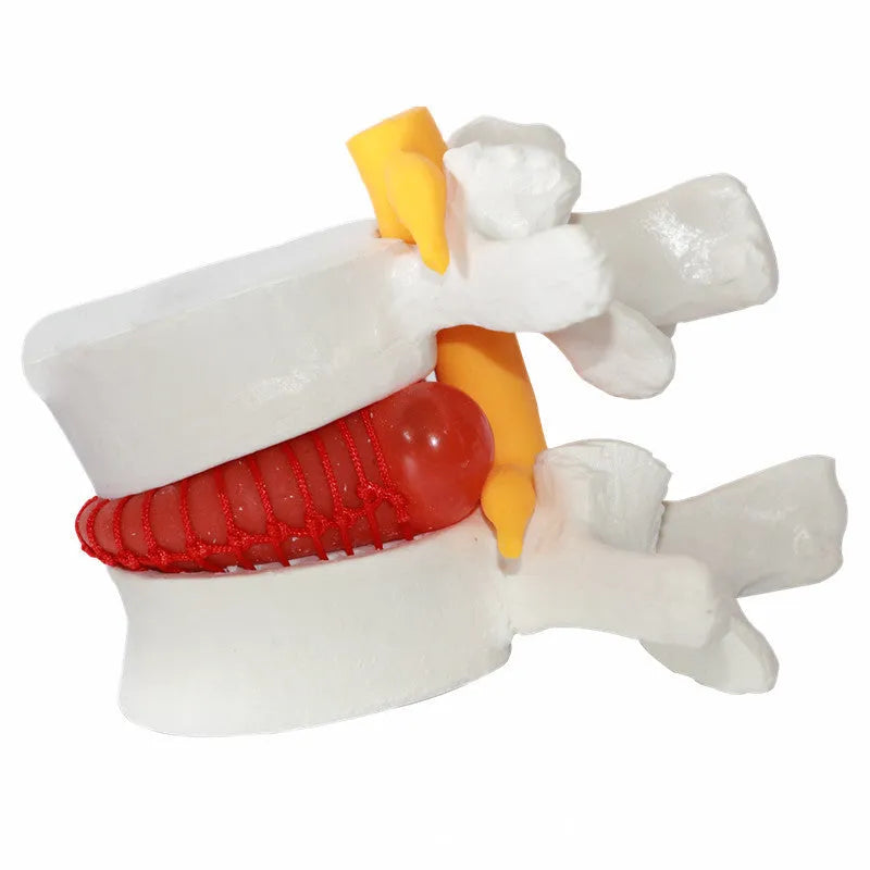 White PVC anatomical model showing a lumbar spinal disc herniation for medical demonstration.