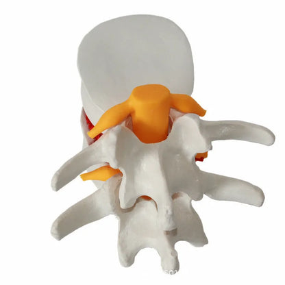 White PVC anatomical model showing a lumbar spinal disc herniation for medical demonstration.