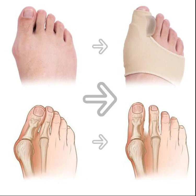 Big Foot Valgus Corrector in skin tone and white, designed for all-day wear and foot alignment correction