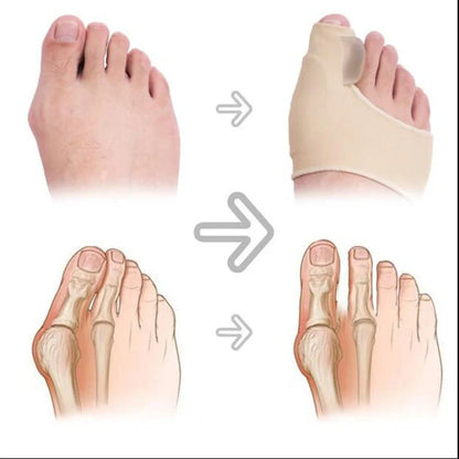 Big Foot Valgus Corrector in skin tone and white, designed for all-day wear and foot alignment correction