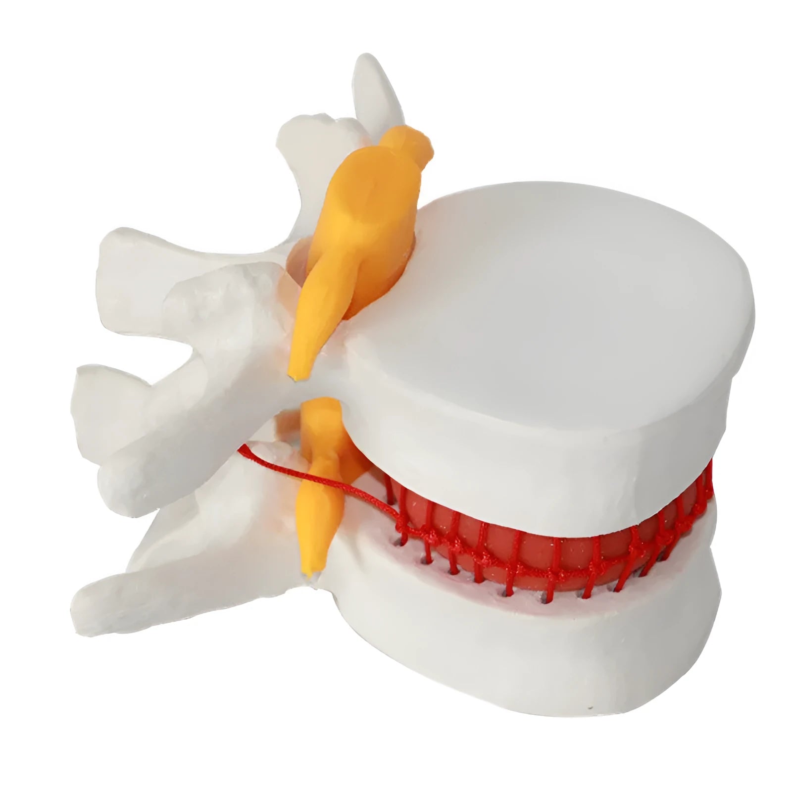 White PVC anatomical model showing a lumbar spinal disc herniation for medical demonstration.