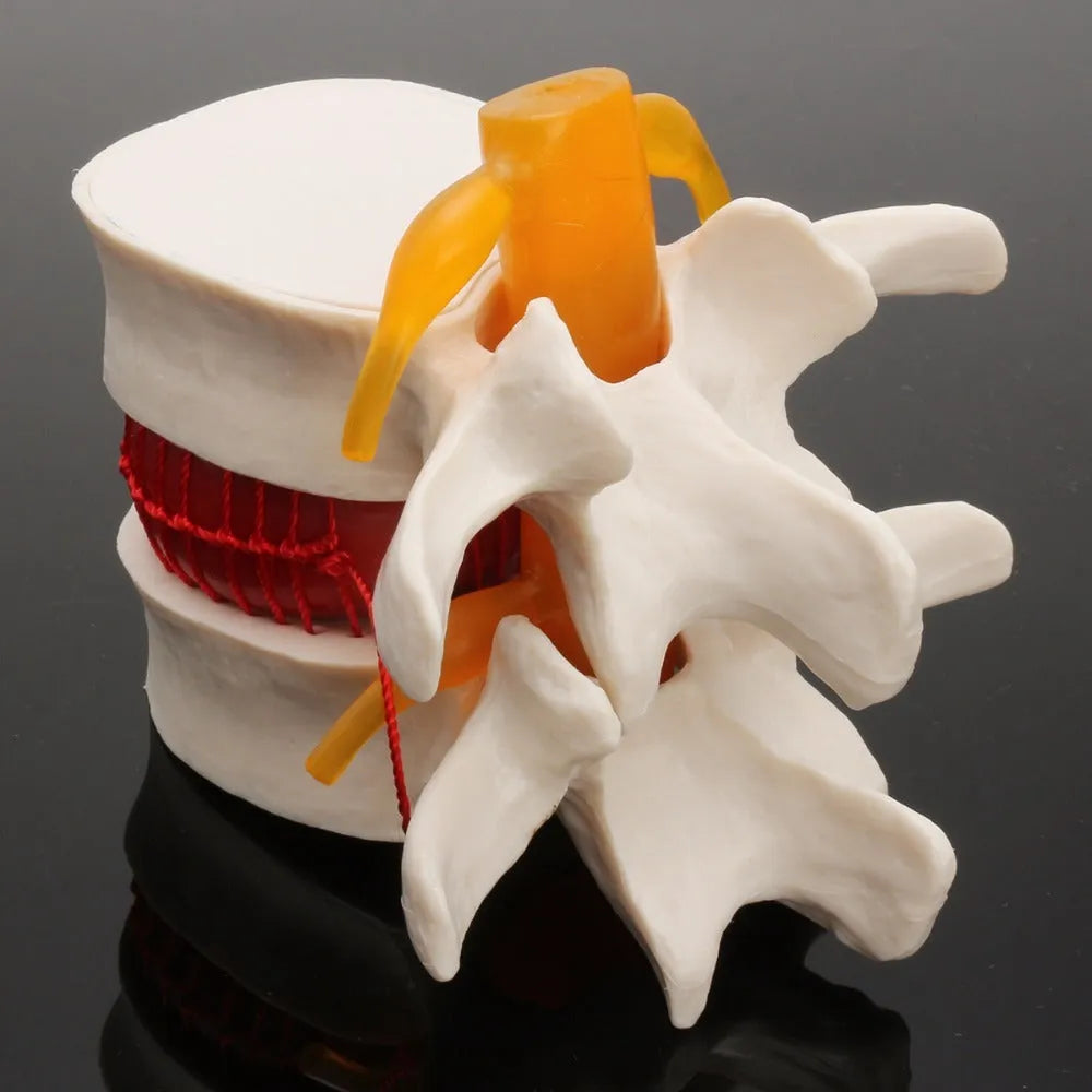 White PVC anatomical model showing a lumbar spinal disc herniation for medical demonstration.
