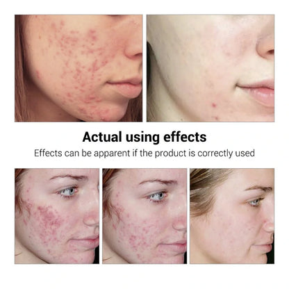 BREYLEE Acne Treatment Serum with plant extracts for acne-prone skin