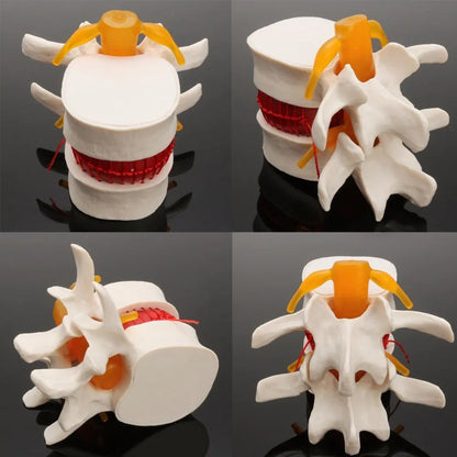 White PVC anatomical model showing a lumbar spinal disc herniation for medical demonstration.