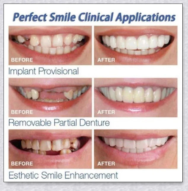 Snap-On Veneers: Disguise dental imperfections and upgrade your smile instantly