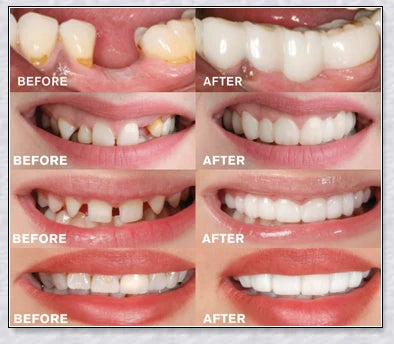 Snap-On Veneers: Disguise dental imperfections and upgrade your smile instantly