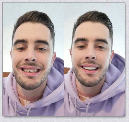 Snap-On Veneers: Disguise dental imperfections and upgrade your smile instantly