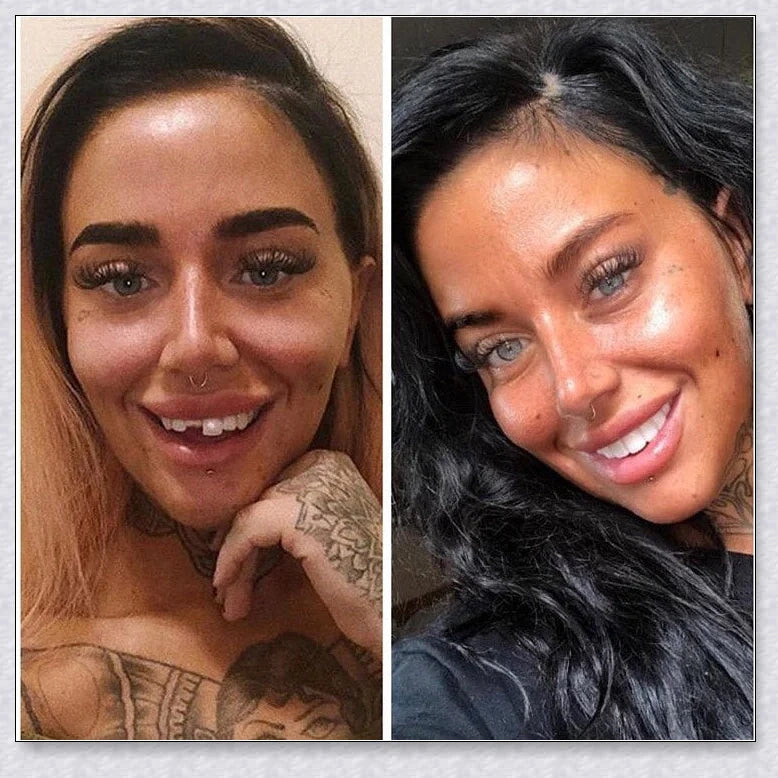Snap-On Veneers: Disguise dental imperfections and upgrade your smile instantly