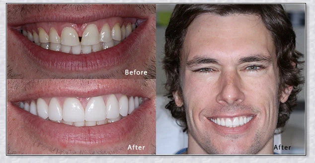 Snap-On Veneers: Disguise dental imperfections and upgrade your smile instantly