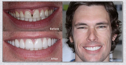 Snap-On Veneers: Disguise dental imperfections and upgrade your smile instantly