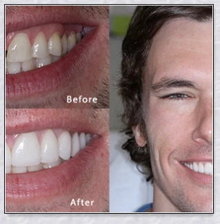 Snap-On Veneers: Disguise dental imperfections and upgrade your smile instantly
