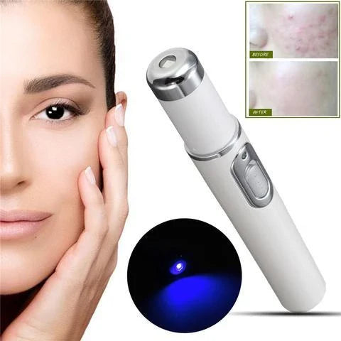 Advanced Blue Light Therapy Acne Pen - Targets Acne, Reduces Scarring, and Rejuvenates Skin
