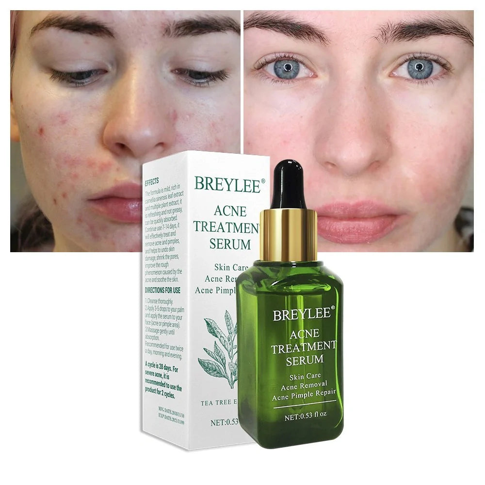 BREYLEE Acne Treatment Serum with plant extracts for acne-prone skin