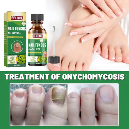 30ml bottle of tea tree oil nail repair fluid for hand and foot care.