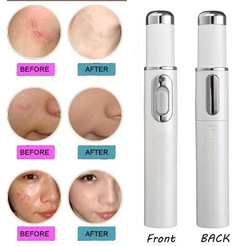 Advanced Blue Light Therapy Acne Pen - Targets Acne, Reduces Scarring, and Rejuvenates Skin