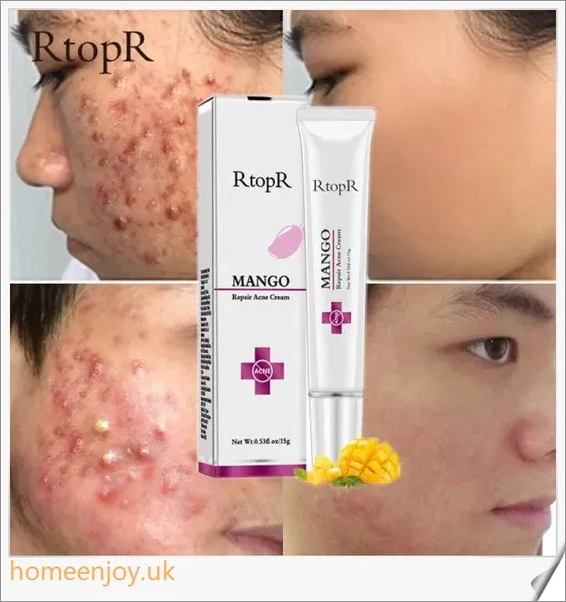 Acne Treatment Face Cream infused with mango extract to moisturise, brighten, and control oil for a flawless, radiant complexion