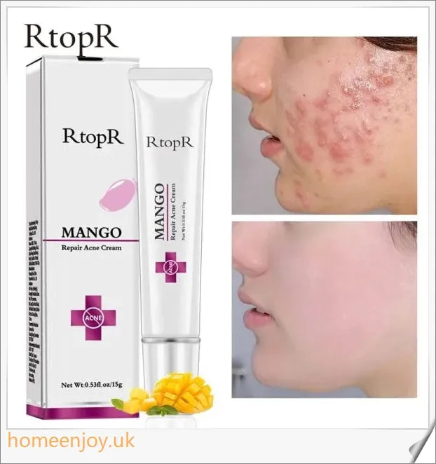 Acne Treatment Face Cream infused with mango extract to moisturise, brighten, and control oil for a flawless, radiant complexion