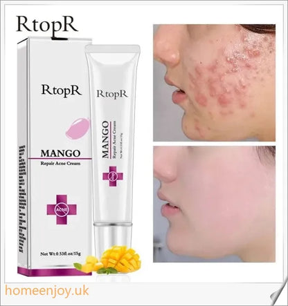 Acne Treatment Face Cream infused with mango extract to moisturise, brighten, and control oil for a flawless, radiant complexion