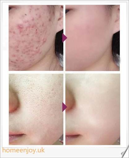 Acne Treatment Face Cream infused with mango extract to moisturise, brighten, and control oil for a flawless, radiant complexion