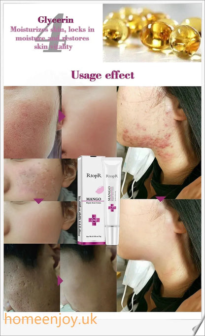 Acne Treatment Face Cream infused with mango extract to moisturise, brighten, and control oil for a flawless, radiant complexion