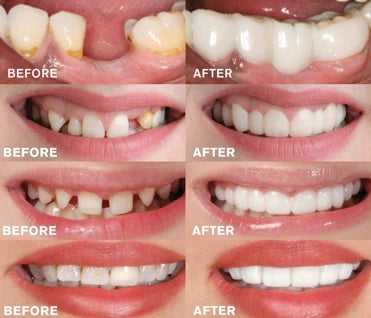 Snap On Dentures - Easily transform your smile with this reusable, natural-looking dental solution