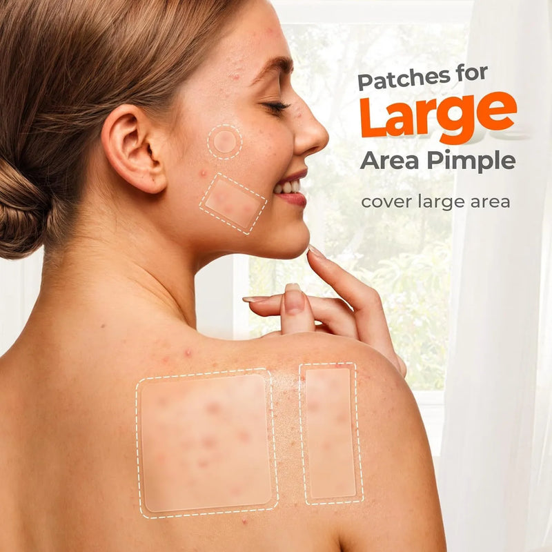 Acne cover patch skincare tool 302-piece box designed for pimple and closed comedone spot treatment, made from plastic material in a transparent colour for discreet daytime or overnight use on facial acne.