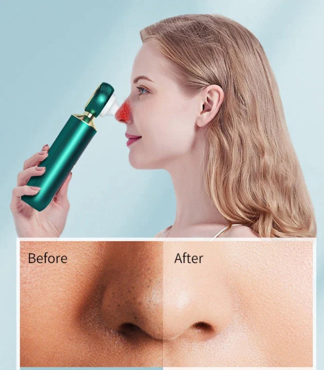 Advanced Blackhead Removal Device with Precision Suction for Clearing Pores and Achieving Radiant Skin