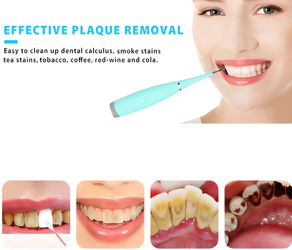 Premium Ultrasonic Sonic Dental Scaler - Powerful vibrations for deep cleaning and teeth whitening